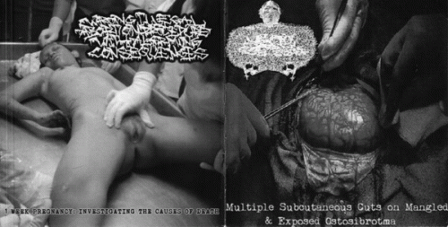 Wrong Illegal Abortion Procedure With Alarming Consequences : Wrong Illegal Abortion Procedure with Alarming Consequences - Urinary Tract Infection from Severe Pu